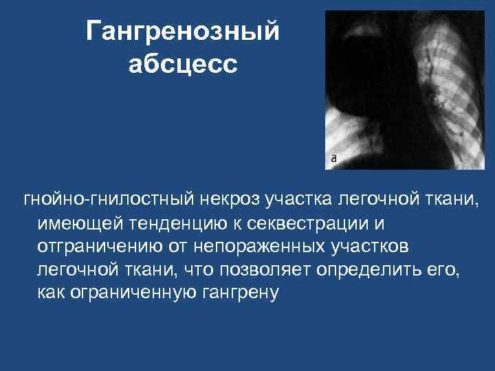 Гангренозный абсцесс гнойно-гнилостный некроз участка легочной ткани, имеющей тенденцию к секвестрации и отграничению от