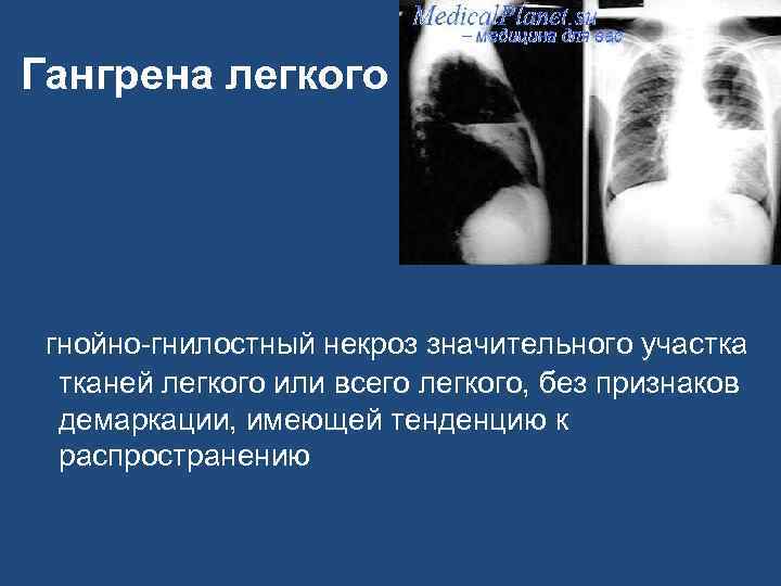 Гангрена легкого гнойно-гнилостный некроз значительного участка тканей легкого или всего легкого, без признаков демаркации,