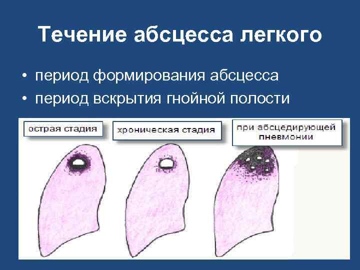  Течение абсцесса легкого • период формирования абсцесса • период вскрытия гнойной полости 