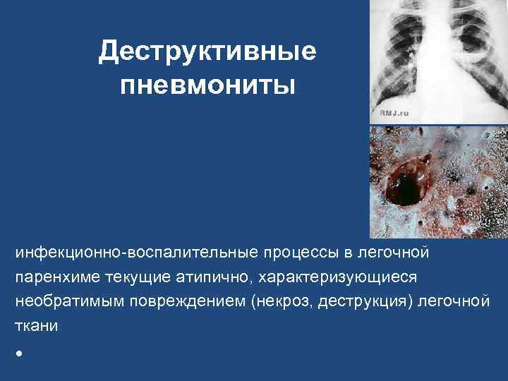 Деструктивные пневмониты инфекционно-воспалительные процессы в легочной паренхиме текущие атипично, характеризующиеся необратимым повреждением (некроз, деструкция)