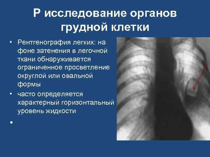 Р исследование органов грудной клетки • Рентгенография легких: на фоне затенения в легочной ткани