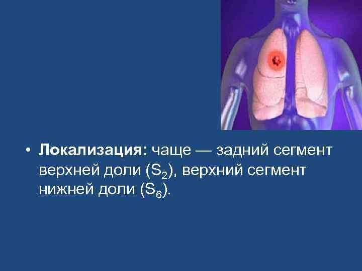  • Локализация: чаще — задний сегмент верхней доли (S 2), верхний сегмент нижней