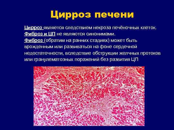 Цирроз печени Цирроз является следствием некроза печёночных клеток. Фиброз и ЦП не являются синонимами.