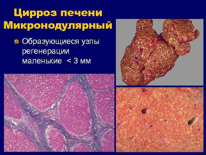 Цирроз печени Микронодулярный Образующиеся узлы регенерации маленькие < 3 мм 