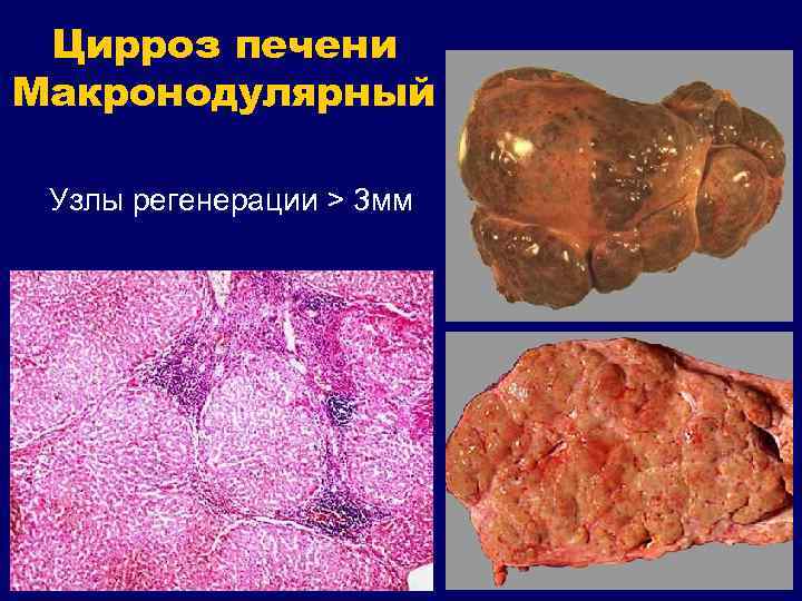 Цирроз печени Макронодулярный Узлы регенерации > 3 мм 