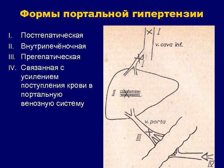 Формы портальной гипертензии Постгепатическая II. Внутрипечёночная III. Прегепатическая IV. Связанная с усилением поступления крови