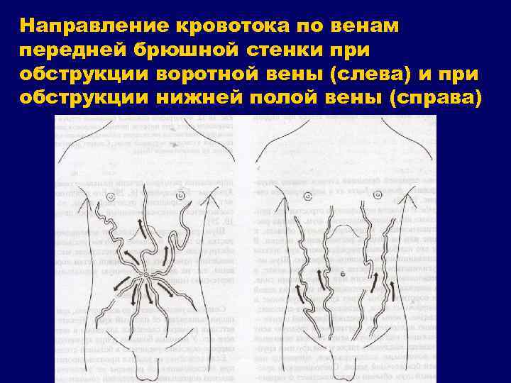 Направление кровотока по венам передней брюшной стенки при обструкции воротной вены (слева) и при