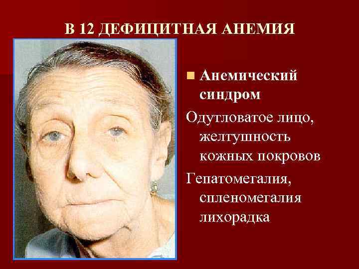 В 12 ДЕФИЦИТНАЯ АНЕМИЯ n Анемический синдром Одутловатое лицо, желтушность кожных покровов Гепатомегалия, спленомегалия