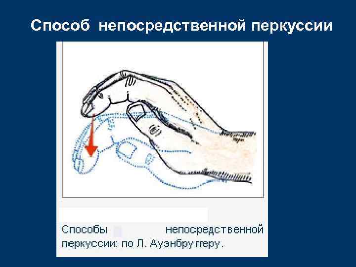 Способ непосредственной перкуссии 