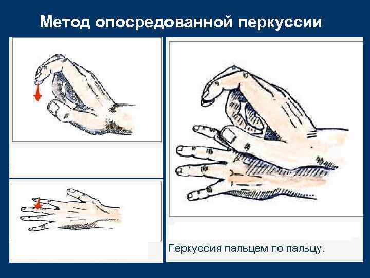Метод опосредованной перкуссии 