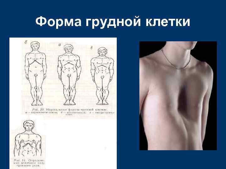 Форма грудной клетки 