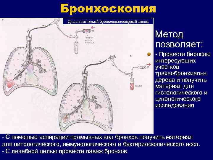 Бронхоскопия Диагностический бронхоальвеолярный лаваж Метод позволяет: - Провести биопсию интересующих участков трахеобронхиальн. дерева и