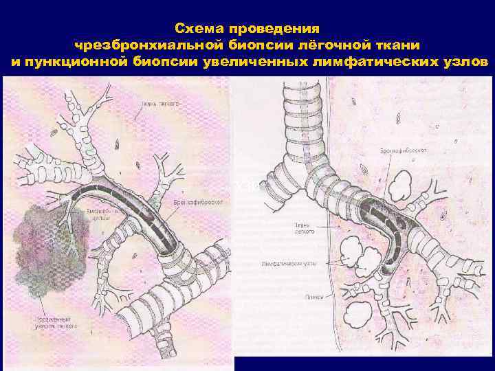 Схема проведения чрезбронхиальной биопсии лёгочной ткани и пункционной биопсии увеличенных лимфатических узлов УЗИ 
