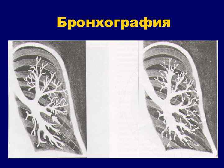 Бронхография 