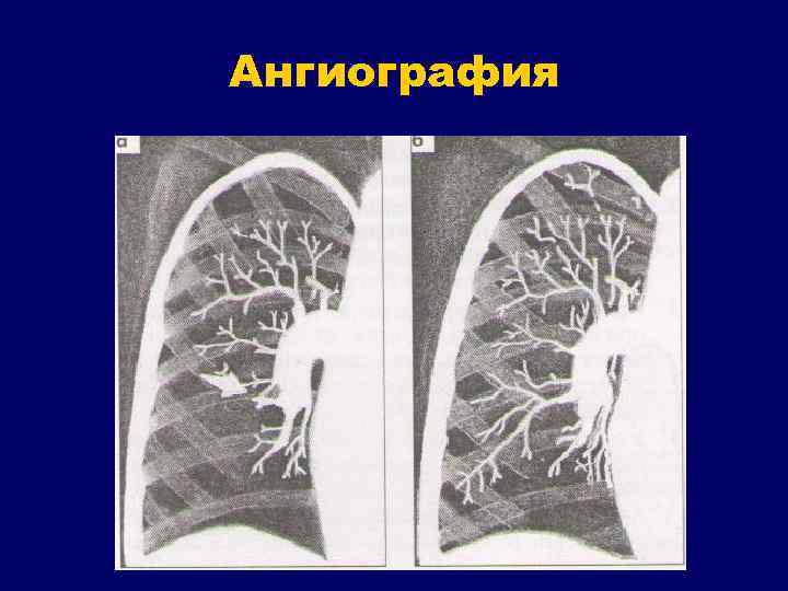 Ангиография 