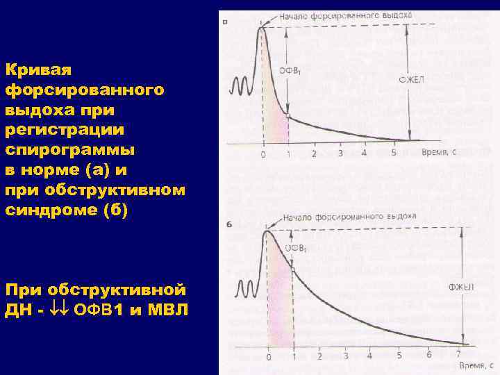 Кривая форсированного выдоха при регистрации спирограммы в норме (а) и при обструктивном синдроме (б)