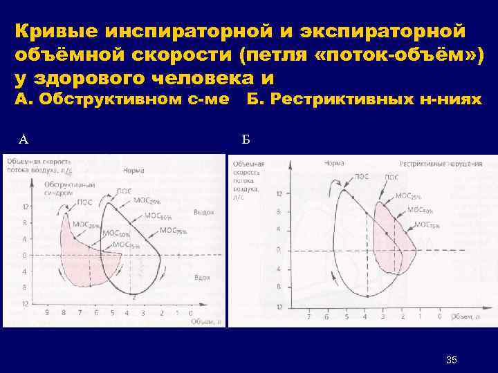 Кривые инспираторной и экспираторной объёмной скорости (петля «поток-объём» ) у здорового человека и А.