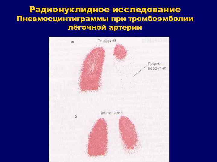 Радионуклидное исследование Пневмосцинтиграммы при тромбоэмболии лёгочной артерии 