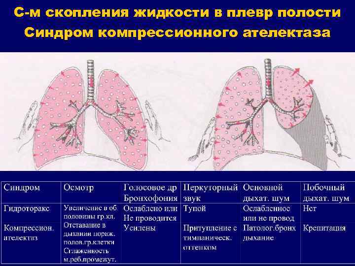 С-м скопления жидкости в плевр полости Синдром компрессионного ателектаза 