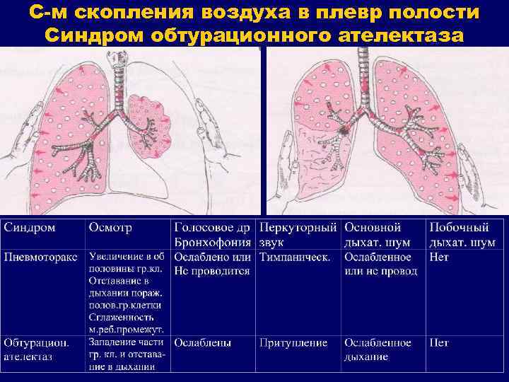 С-м скопления воздуха в плевр полости Синдром обтурационного ателектаза 