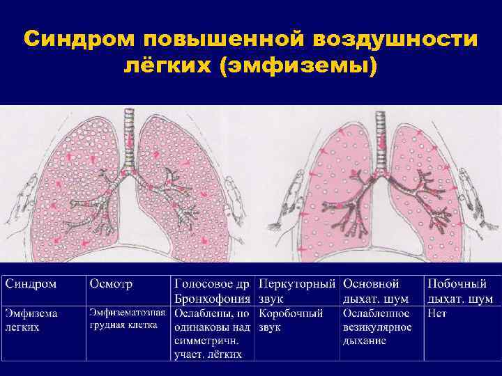 Синдром повышенной воздушности лёгких (эмфиземы) 
