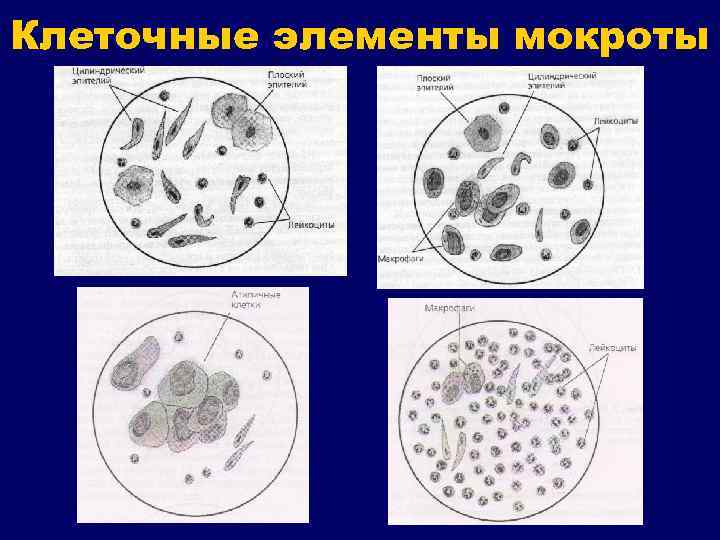 Клеточные элементы мокроты 