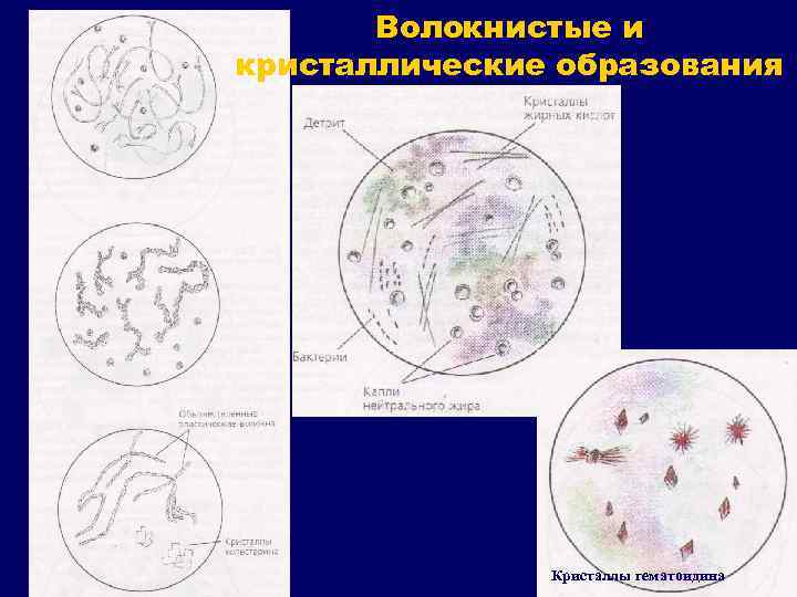 Волокнистые и кристаллические образования Кристаллы гематоидина 