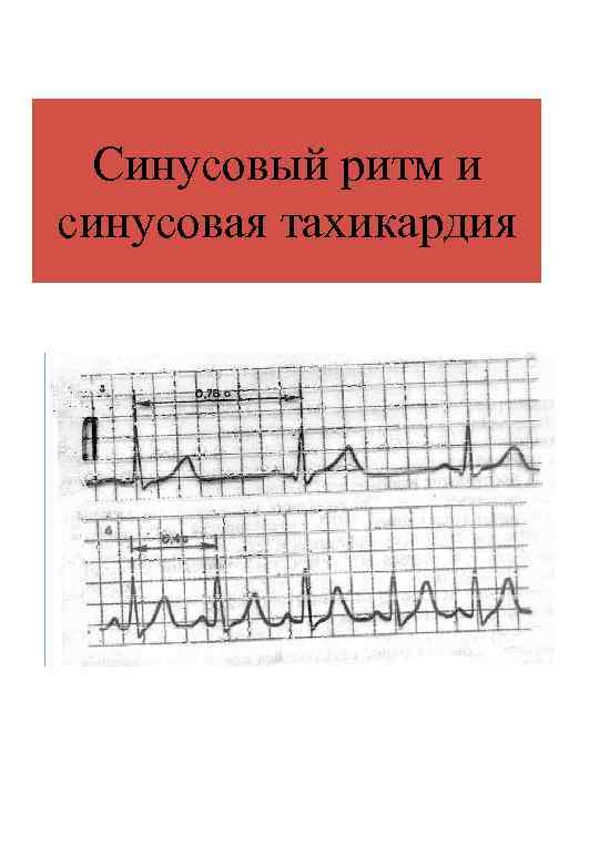 Синусовый ритм и синусовая тахикардия 