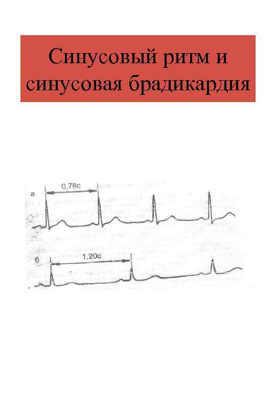 Синусовый ритм и синусовая брадикардия 