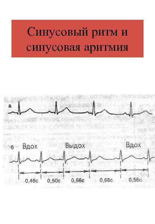 Синусовый ритм и синусовая аритмия 
