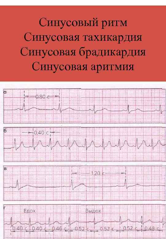 Синусовый ритм Синусовая тахикардия Синусовая брадикардия Синусовая аритмия 