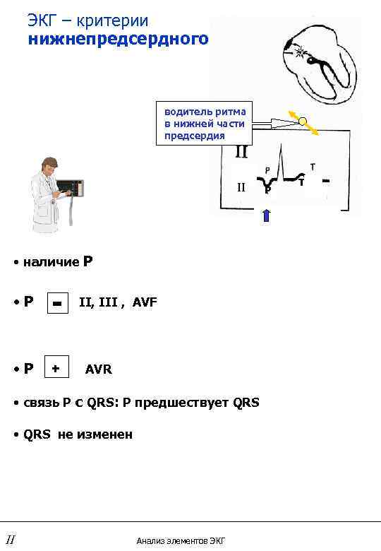 ЭКГ – критерии нижнепредсердного ритма водитель ритма в нижней части предсердия II • наличие