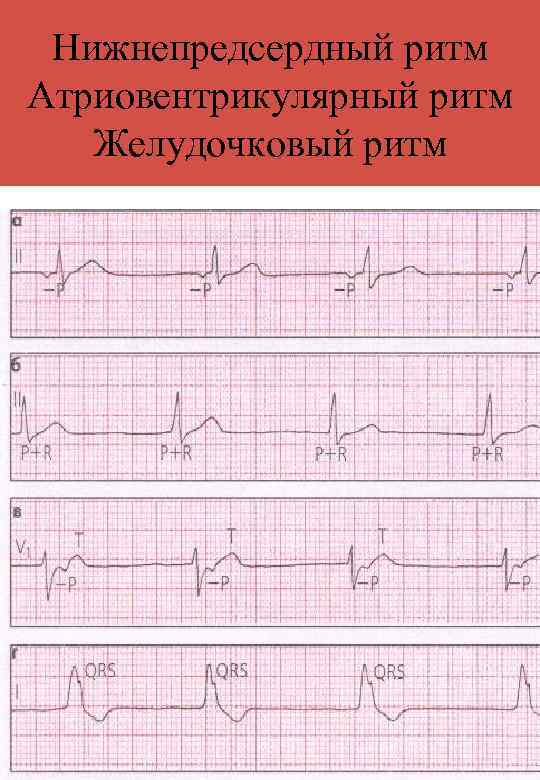 Нижнепредсердный ритм Атриовентрикулярный ритм Желудочковый ритм 