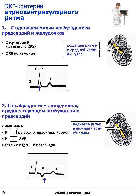 ЭКГ-критерии атриовентрикулярного ритма 1. С одновременным возбуждением предсердий и желудочков • Отсутствие Р (сливается
