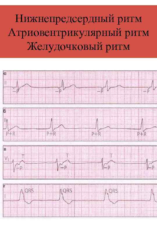 Нижнепредсердный ритм Атриовентрикулярный ритм Желудочковый ритм 