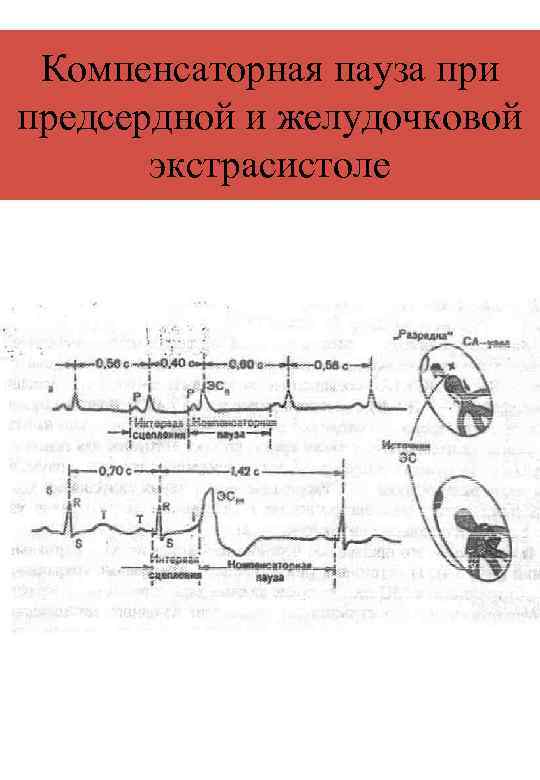 Компенсаторная пауза при предсердной и желудочковой экстрасистоле 