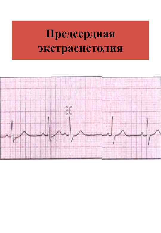 Предсердная экстрасистолия 
