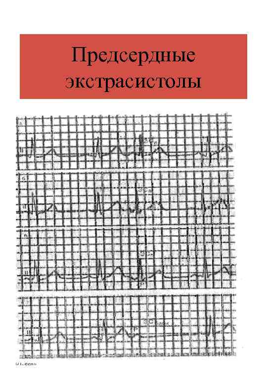 Предсердные экстрасистолы 