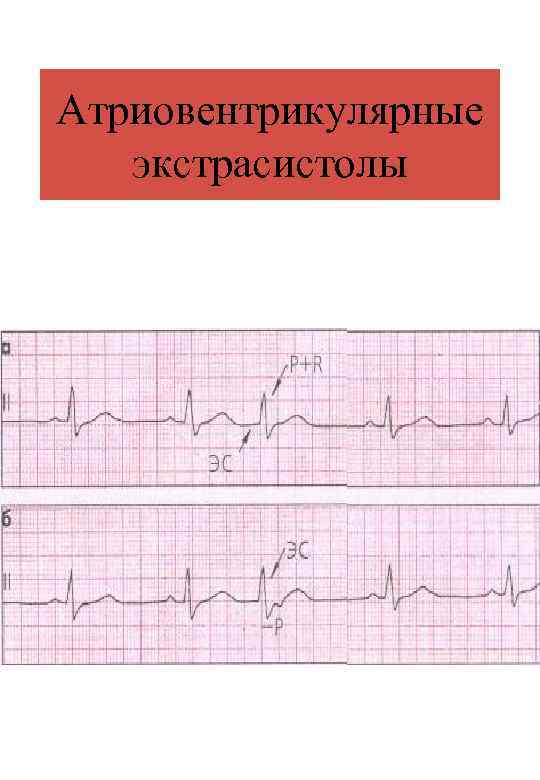 Атриовентрикулярные экстрасистолы 