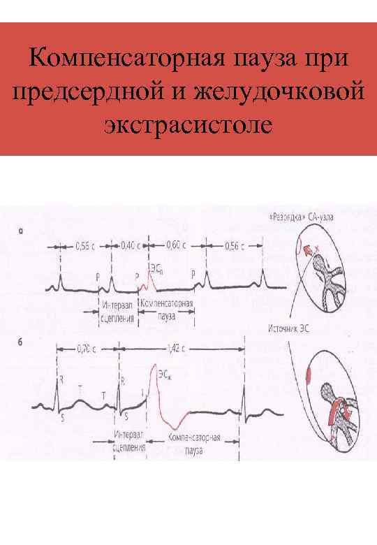 Компенсаторная пауза при предсердной и желудочковой экстрасистоле 