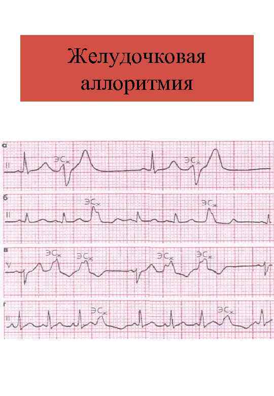 Желудочковая аллоритмия 
