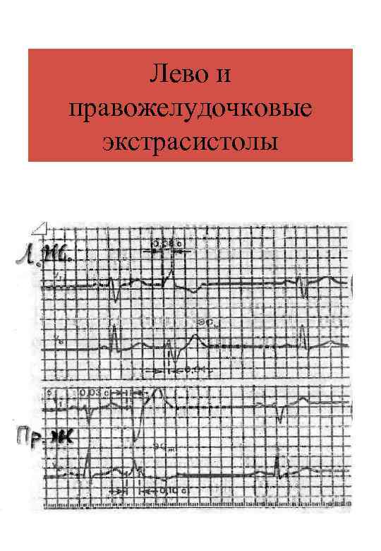Лево и правожелудочковые экстрасистолы 