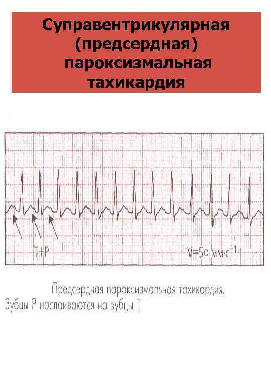 Суправентрикулярная (предсердная) пароксизмальная тахикардия 