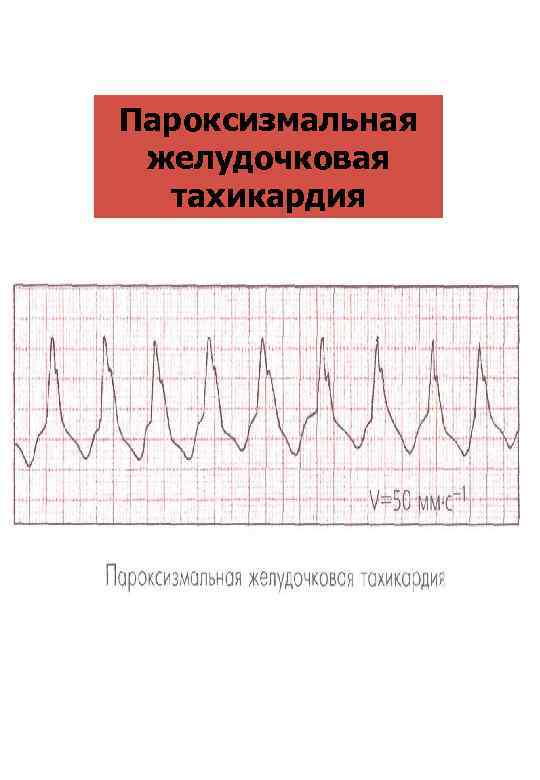 Пароксизмальная желудочковая тахикардия 
