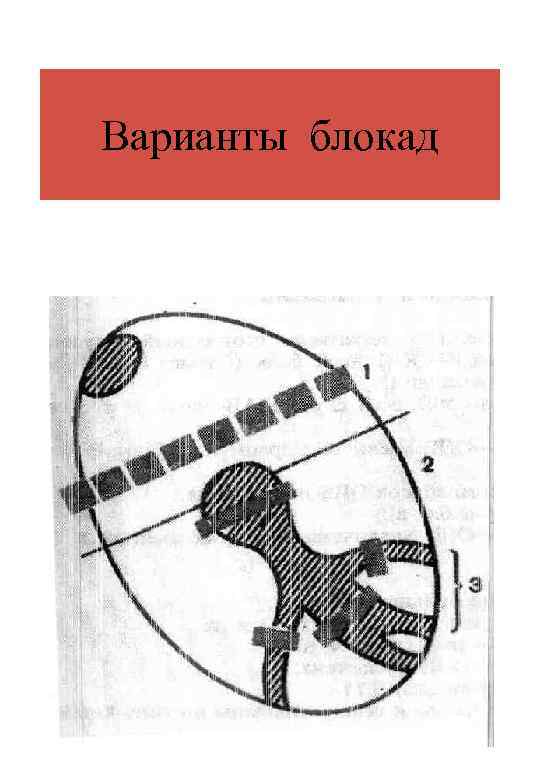 Варианты блокад 