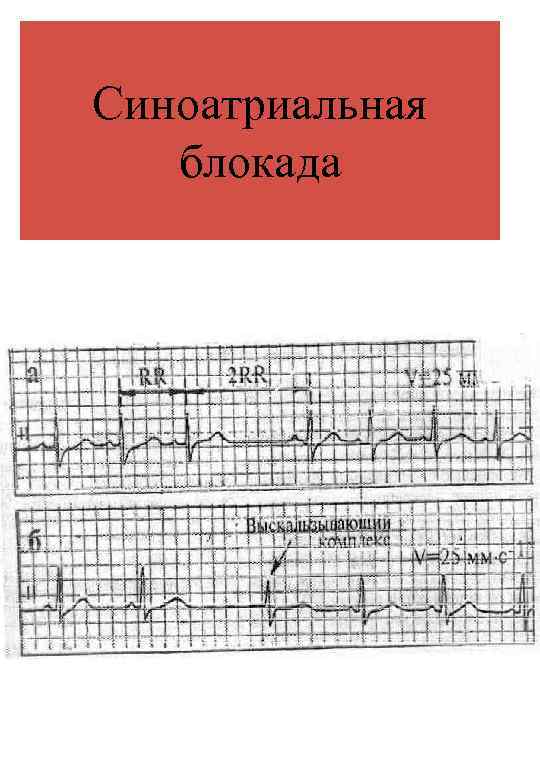 Синоатриальная блокада 