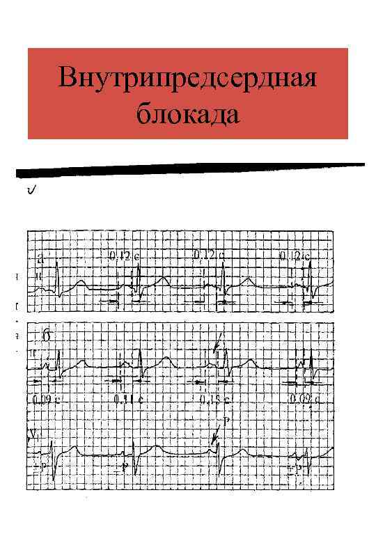 Внутрипредсердная блокада 