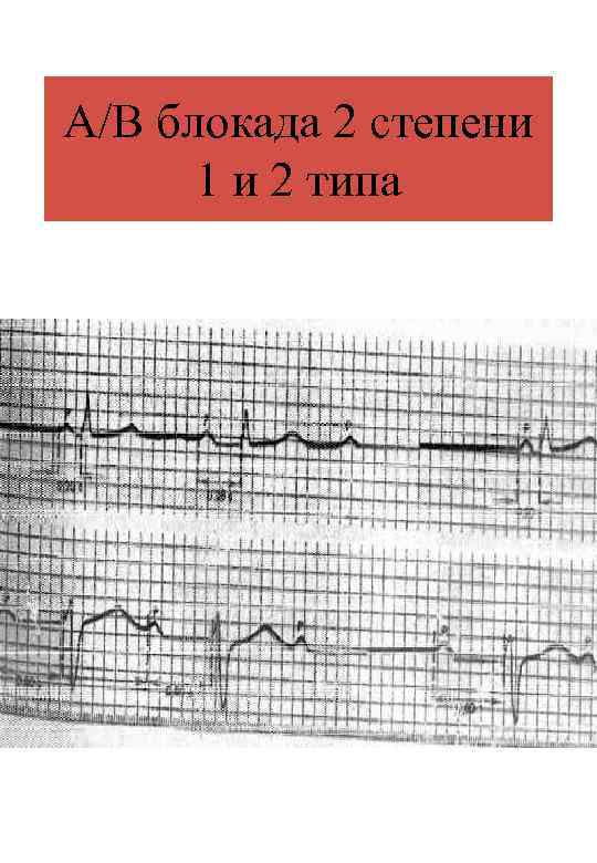 А/В блокада 2 степени 1 и 2 типа 