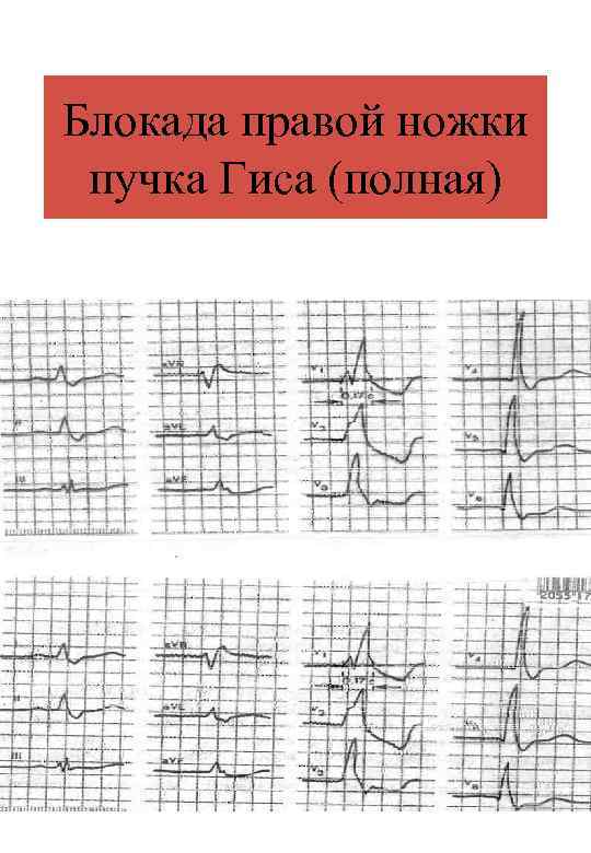 Блокада правой ножки пучка Гиса (полная) 
