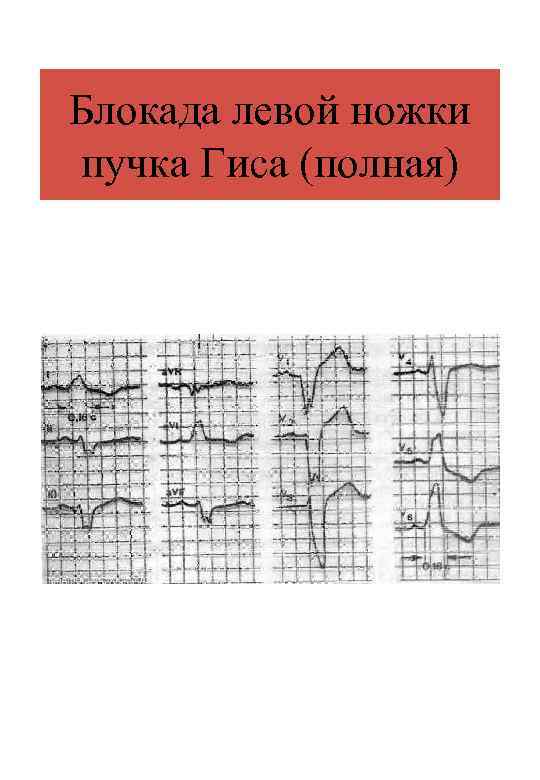Блокада левой ножки пучка Гиса (полная) 